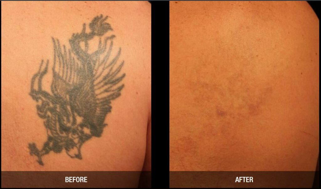Tattoo Removal Results In Ogden Utah