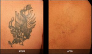Tattoo Removal Results in Ogden Utah