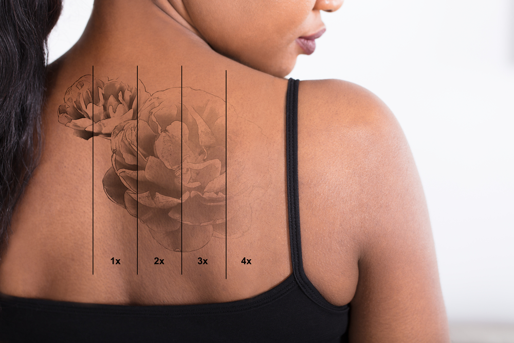 Can You Completely Remove A Tattoo? | Regeneration Medical Spa