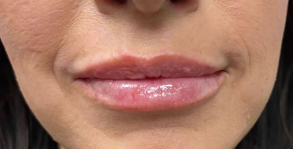 after-fuller-lips