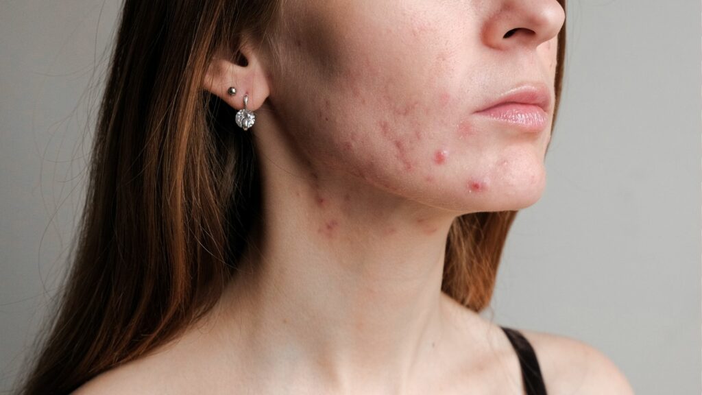 A sideview image of woman with acne
