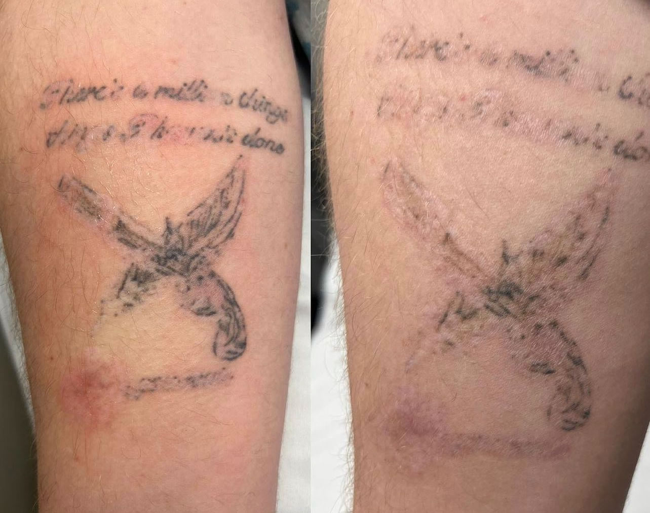 Before and after images of tattoo removal procedure showcasing the effectiveness of the treatment.