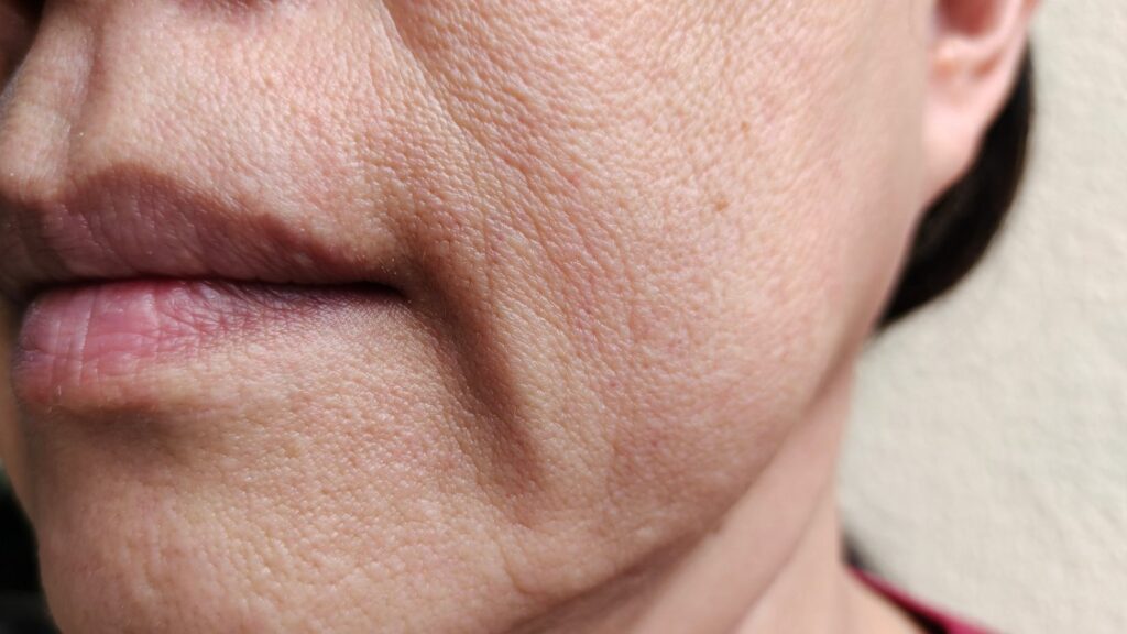 Skin aging in the cheeks