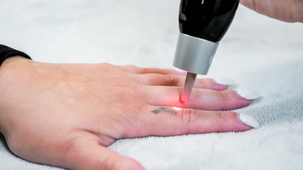 Removing the tattoo in the thumb using laser.