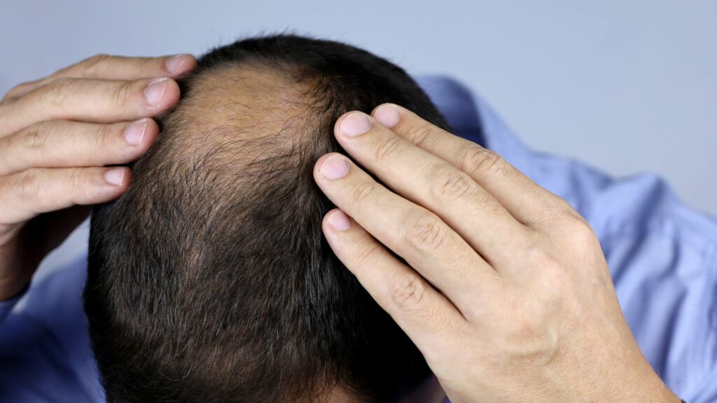Man touching his hair for a hair loss problem.