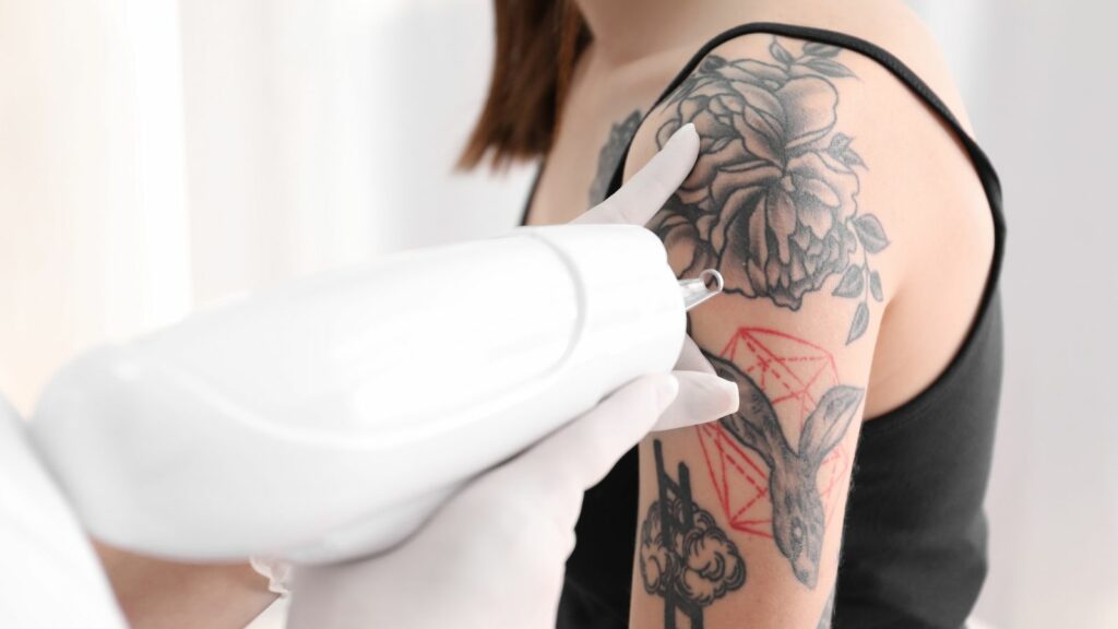 Remove Tattoos from the Shoulder of a Woman